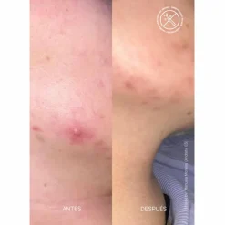 ZITCONTROL Blemish Control Moisturizer 40 ml