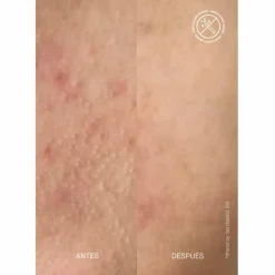 Zitmask® Anti-Pickel-Maske mit Sulfur 100 ml